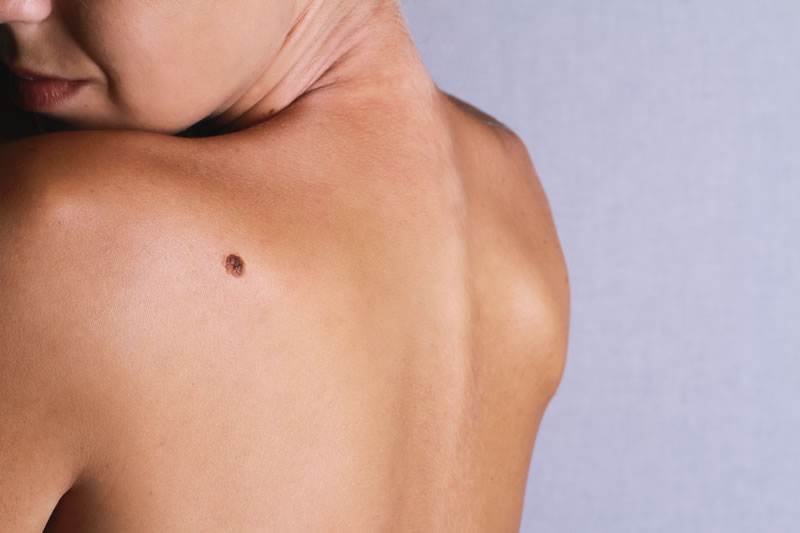 Skin Lesions